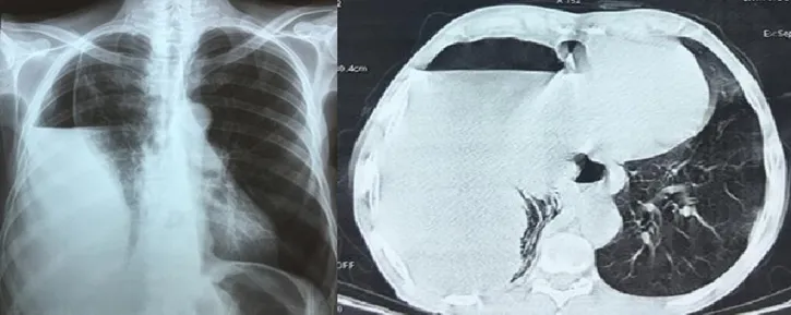 Diaphragmatic Hydatid Cyst, A Rare Entity Simulating A Thoracic
